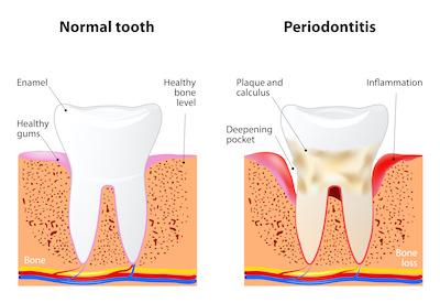 Tooth Gum Disease Illustration