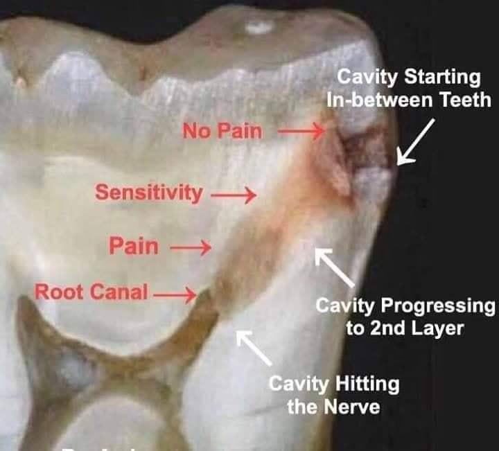 Progression of Dental Decay illustration in Shiflett Family Dental
