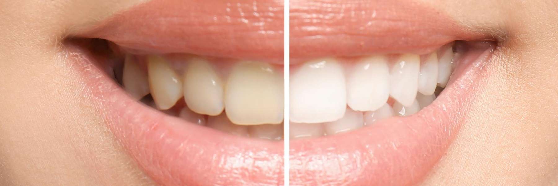 Yellow teeth vs white teeth of a woman in Colombus.