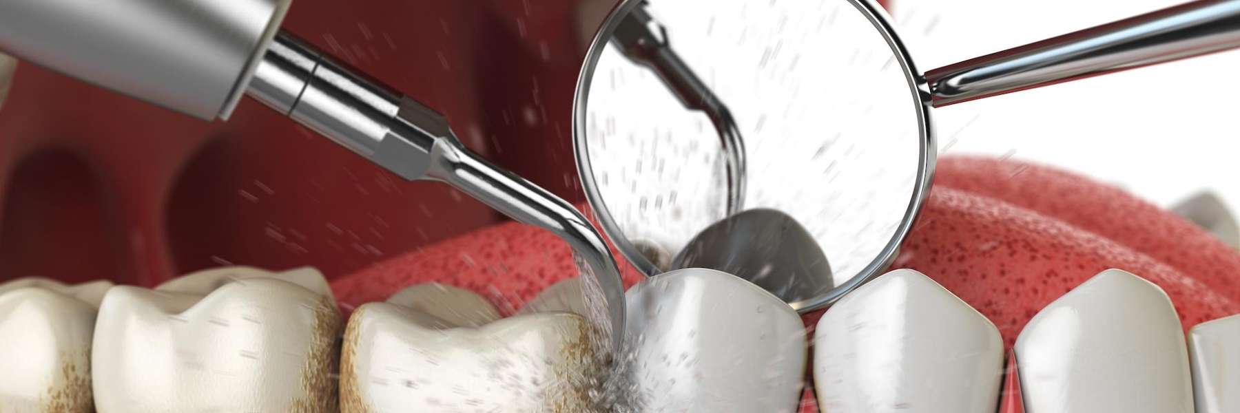 Dental cleaning of molar stains in Columbus OH
