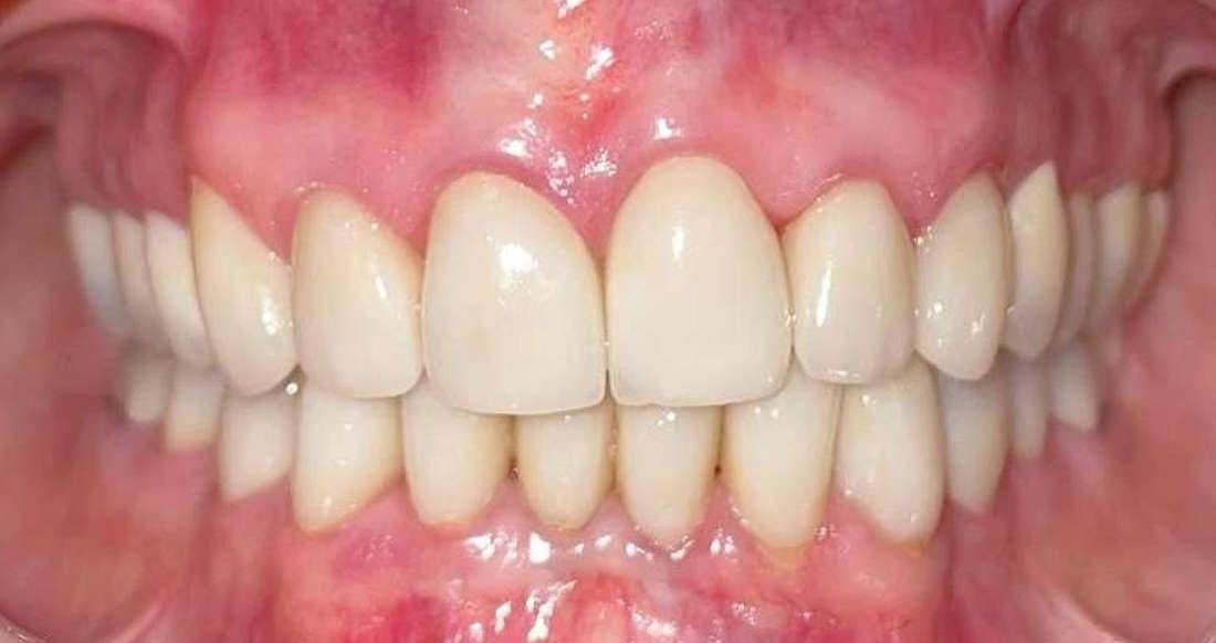 After full mouth rehabilitation, clintontville oh