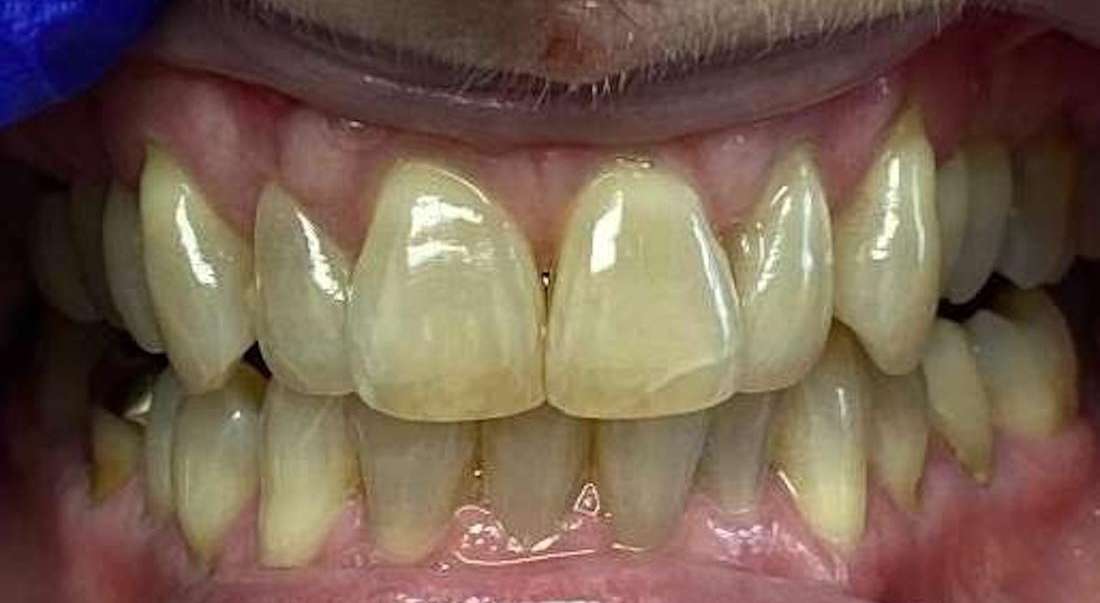 Before clear aligners, clintonville oh