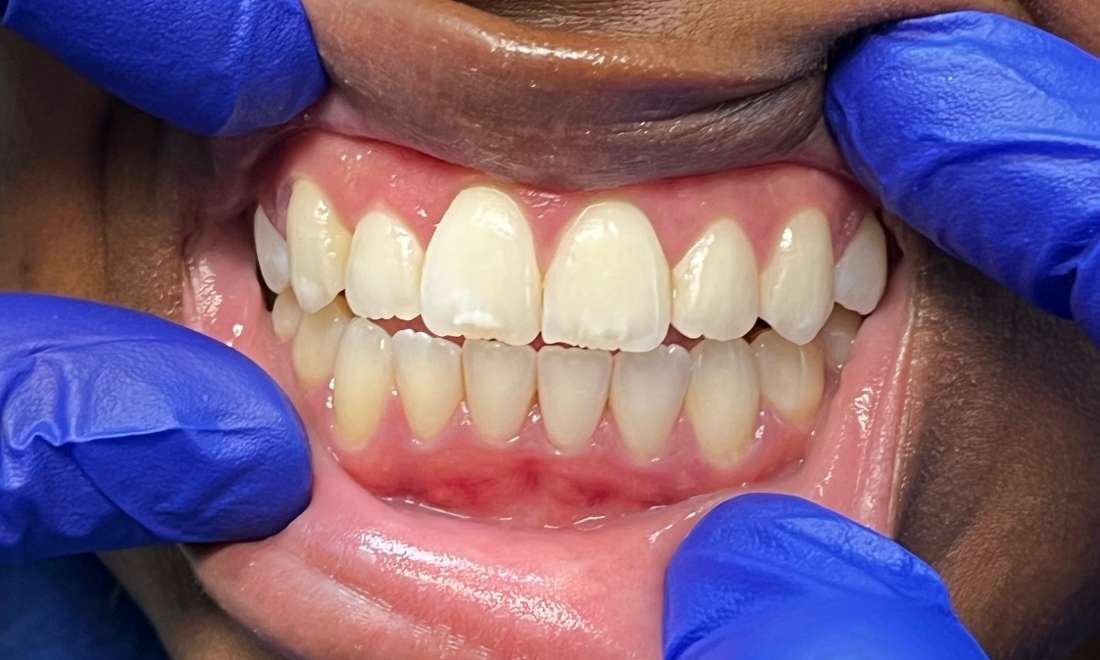 ICON White Spot Treatment in Columbus- Before