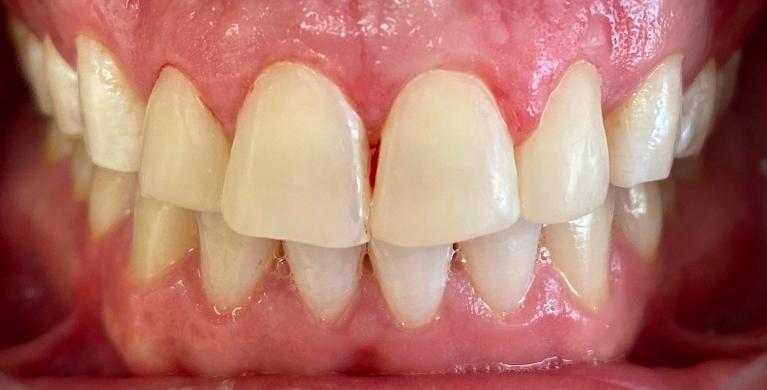 Complete-Your-Smile-With-Composite-Veneers-After-Image