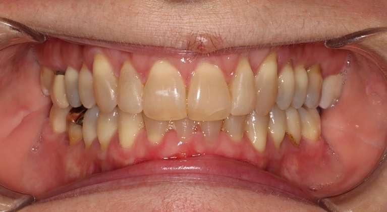Fixing-a-smile-with-Clear-Aligners-After-Image