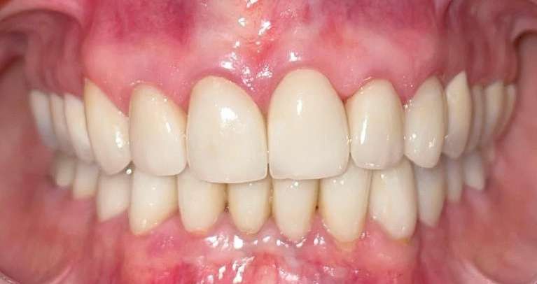 Full-Mouth-Rehabilitation-After-Image