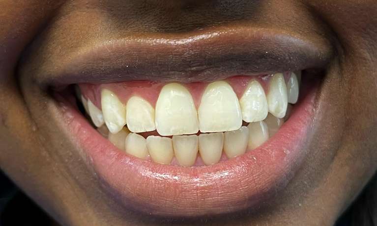 ICON-White-Spot-Treatment-After-Image