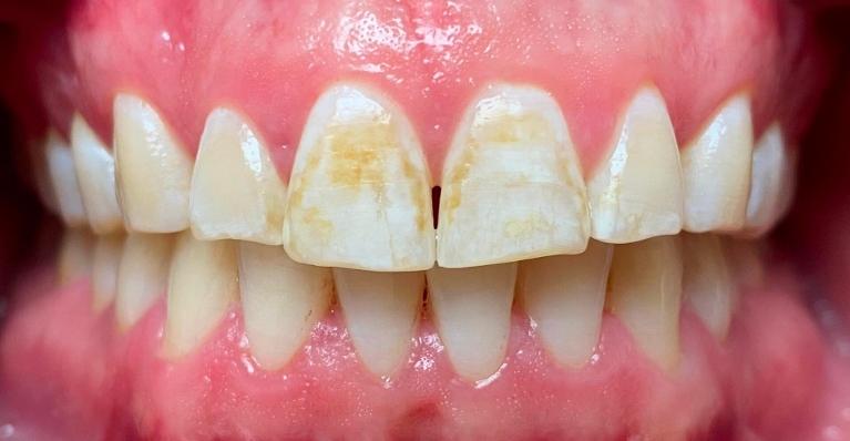 Complete-Your-Smile-With-Composite-Veneers-Before-Image