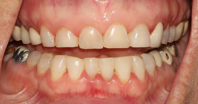 Full-Mouth-Rehabilitation-Before-Image